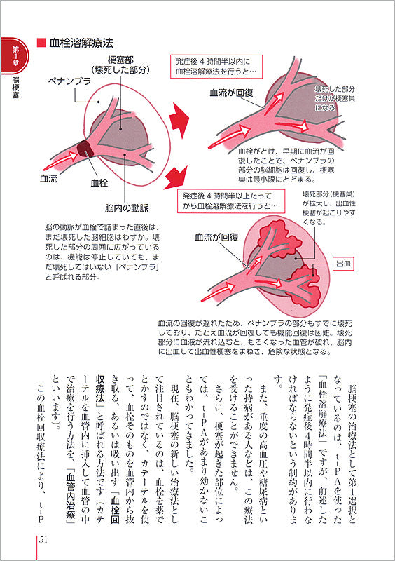 患者のための最新医学　脳梗塞・脳出血・くも膜下出血